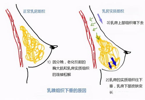 乳房下垂，乳房下垂可以改善吗