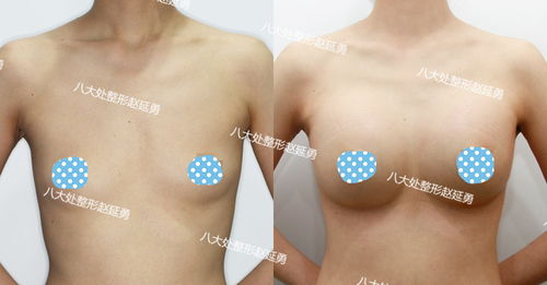 隆胸最大可以隆多大，隆胸手术效果图片