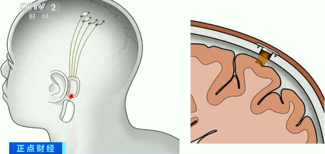 去掉部分头骨，植入芯片！马斯克又有新动作！面向全球招收