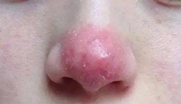  揭秘玫瑰痤疮，症状、原因与治疗方法--第1张