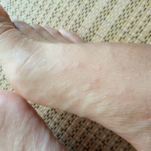 脚上起小水泡还很痒是怎么回事儿 脚上起小水泡还很痒是怎么回事 --第1张