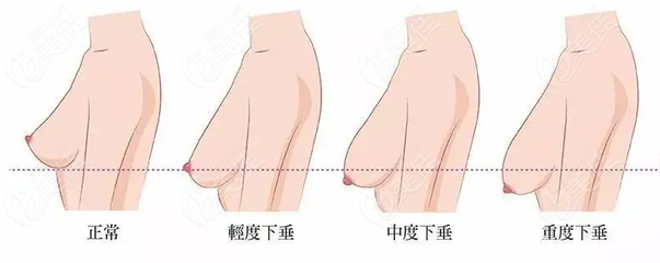 胸下垂松弛手术多少钱，乳房下垂怎样恢复紧实