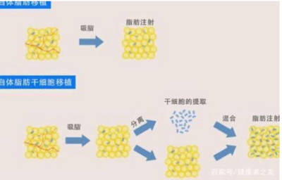 脂肪丰胸可以维持多长时间，脂肪丰胸可以维持几年