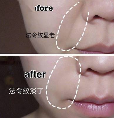 法令纹嘴角纹用什么填充最好，法令纹嘴角下垂松弛怎么改善