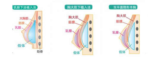 真假胸区别方法，区分真假胸