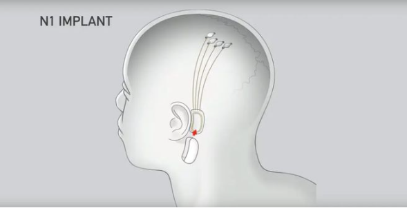 人脑实验在即、数千人排队等待，马斯克“脑机接口”公司Neuralink再融4300万美元